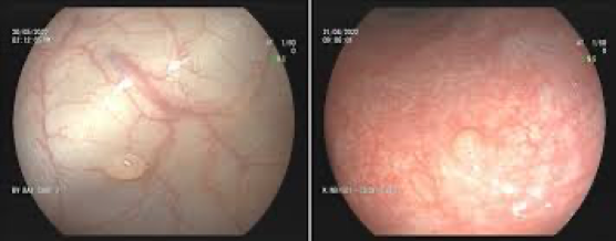 polyp tăng sản.png